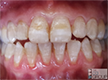 Fluorosis Thumbnail Pic